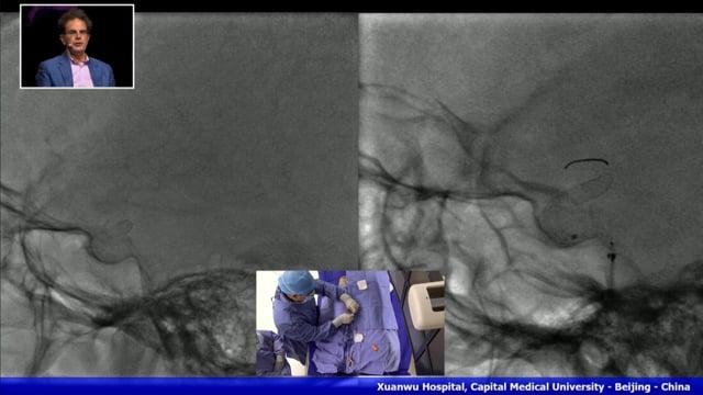 Paraclinoid ICA Aneurysm treated with FD