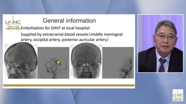 Hybrid Therapy for a Dural ArterioVenous Fistula (DAVF) with Dural and Pial Arterial Supplies