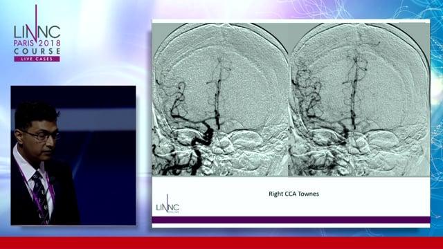 Revascularisation of chronic total occlusion of the CCA to enable access to the MCA for emergency Mechanical thrombectomy
