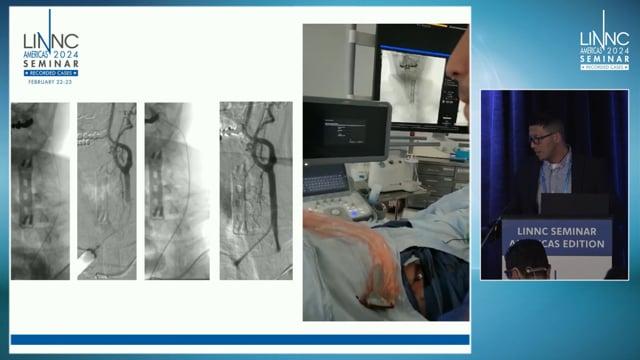 When in stroke the catheter is lost