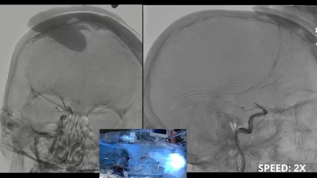 Managing secondary medium vessel occlusion (MeVO) following primary aspiration of an unusual terminus ICA occlusion