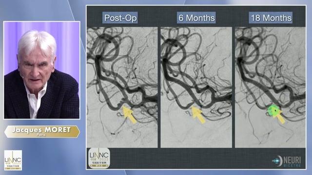 Management of multiple distal MCA aneurysms
