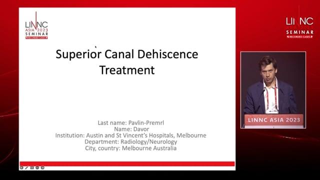Superior Canal Dehiscence