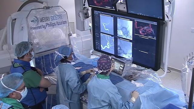 Artisse device in an MCA aneurysm