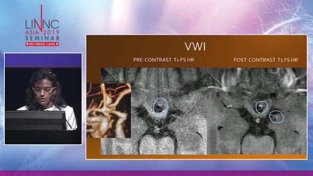 Multiple aneurysms - Who is the culprit?