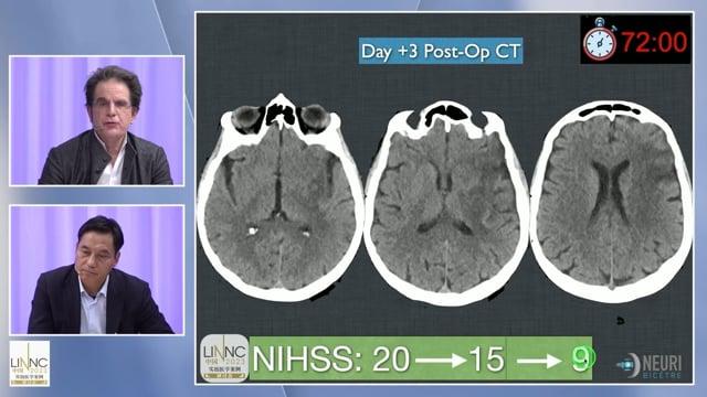 Carotid T thrombectomies: A competitive field between stentriever and aspiration?