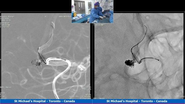 Recurrent ruptured ICA bifurcation aneurysm