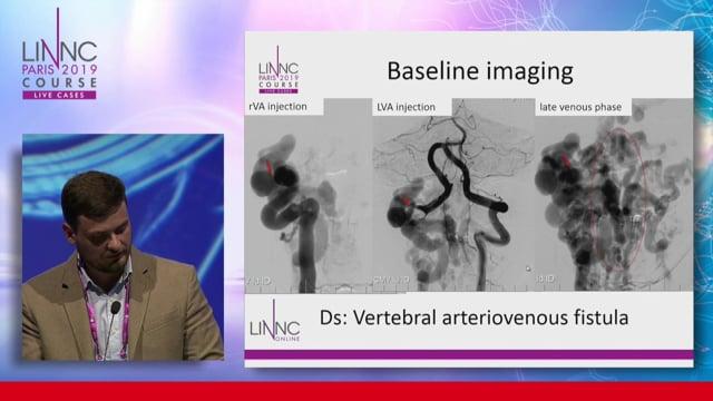 A rare and surprising cause of cervical myelopathy and its endovascular treatment