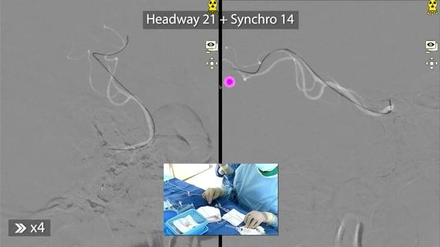 Endovascular Treatment of a Very Distal Occlusion with Mild Stroke Symptoms