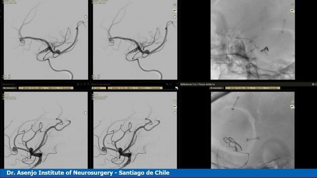 Left Pericallosal Aneurysm
