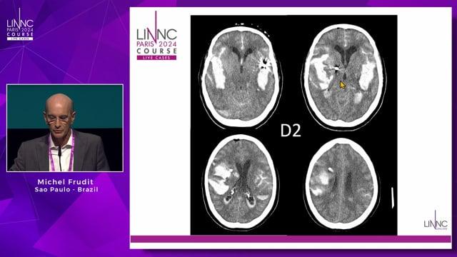 Unexplained hemorrhagic complication of a stent-assisted coiling aneurysm