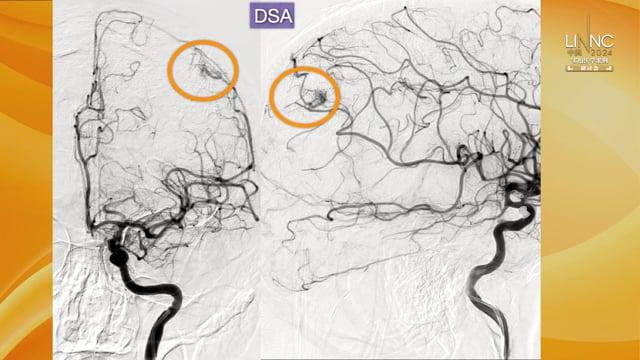 Transvenous treatment of a small cortical parietal ruptured AVM (SM II) with a non adhesive embolic liquid