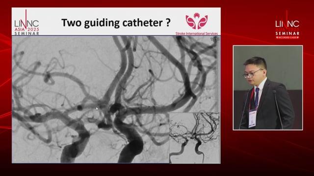 Endovascular treatment of a ruptured heubner’s recurrent artery aneurysm causing subarachnoid  hemorrhage: a rare case report