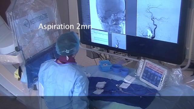Thrombectomy for M1 occlusion