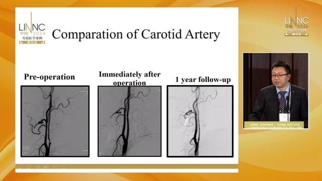 Balloon angioplasty for severe atherosclerotic stenosis at the bifurcation of the middle cerebral artery