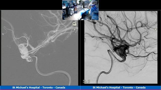 Large paraclinoid aneurysm treated with flow diversion with OCT control