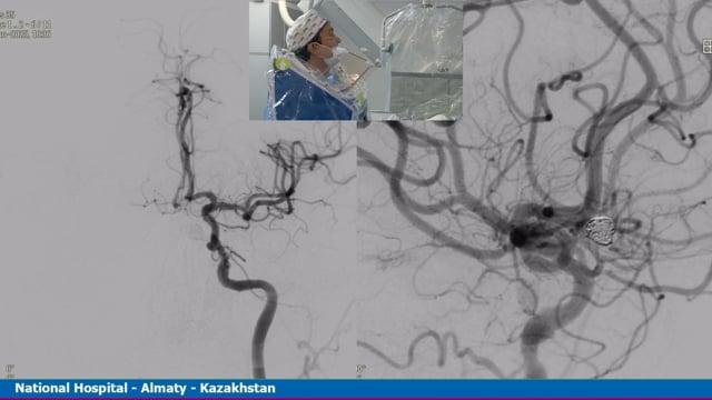 Left ACom aneurysm treated with LVIS EVO assisted coils