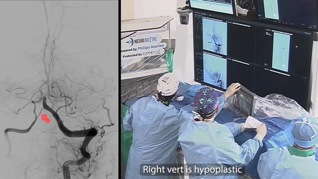 Combined aspiration and stent retriever thrombectomy for severe acute basilar artery occlusion