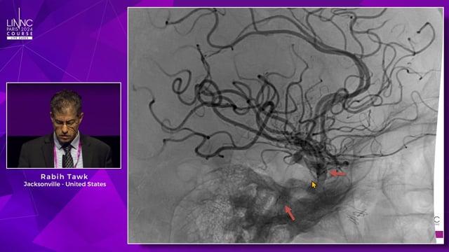 Multifaceted Management of Recurrent Severe Epistaxis Associated with Internal Carotid Artery Pseudoaneurysm and Bilateral Carotid Occlusion: A Case of Strategic Flow Diversion and Endovascular Intervention