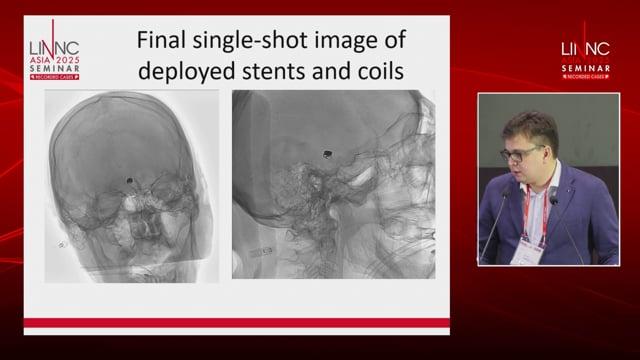 When Collaterals Aren’t Enough- Staged Revascularization Before Aneurysm Coiling