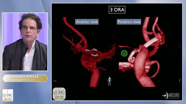 Recurrent Acom and right PCom aneurysms: how would you treat ?