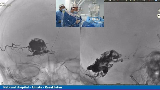 Trans arterial embolization of a ruptured right occipital AVM using Onyx
