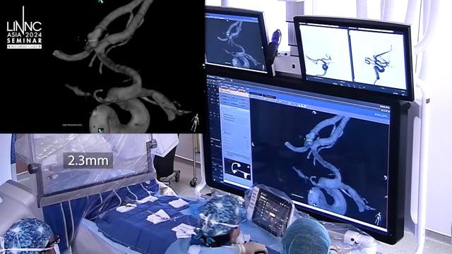 WEB embolization for a small ruptured anterior communicating aneurysm