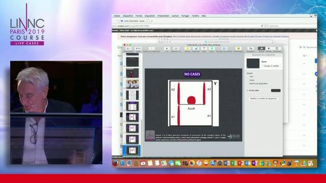 Treating a recurrence of an Acom aneurysm using flow diversion