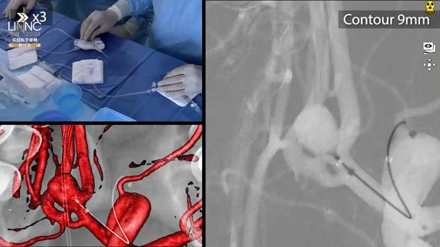 Incidental ACOM aneurysm treated by intra-saccular device