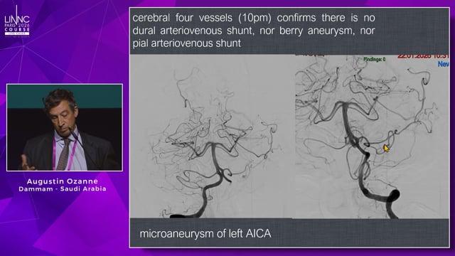 Transarterial embolization with glu of a ruptured dissecting aneurysm of AICA