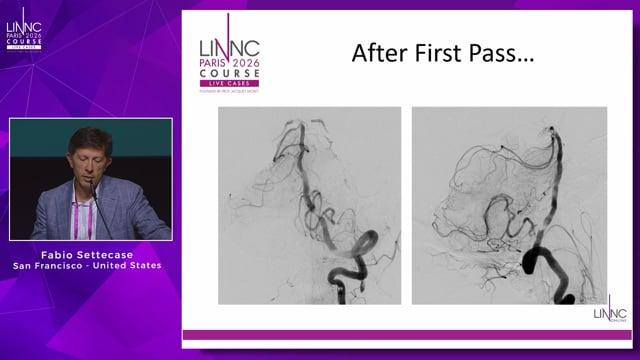 Rescue Dotter Angioplasty and Stenting of ICAD related Basilar LVO