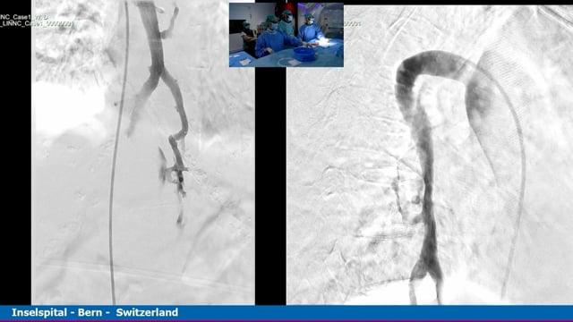 CSF venous fistula