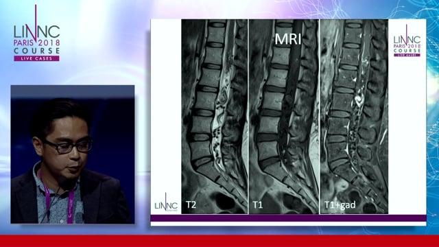 Multiple Spinal Arteriovenous Fistulae: A Case Report 