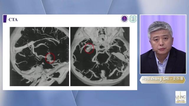 Transvenous Embolization for Basal Ganglia Arteriovenous Malformations