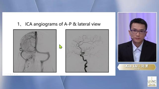 R-MCA ballon angioplasty