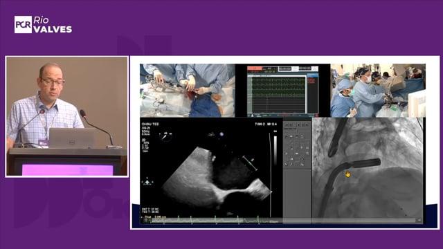 Orthotopic mitral devices