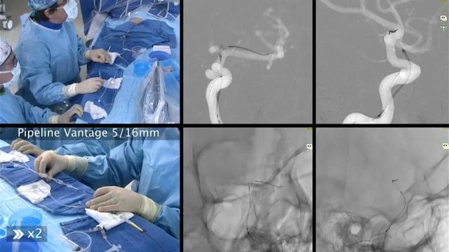 Endovascular Management of a Medially-Pointing Cavernous Carotid Aneurysm