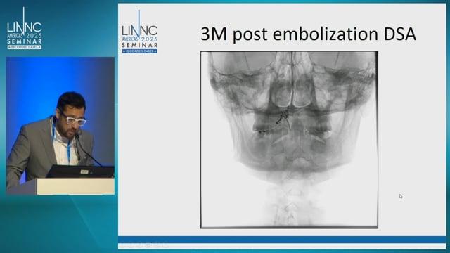 Ruptured Craniocervical AV Fistula: Embolization with Stent Retriever Vessel Protection