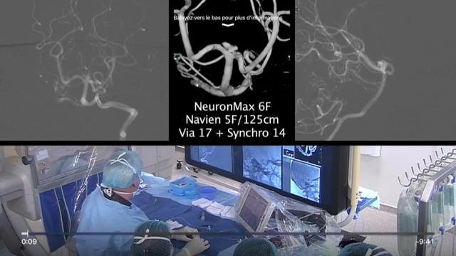Innovative techniques for the treatment of basilar tip aneurysm – the WEB device