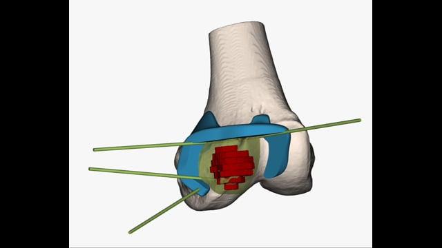Stent failure - LIVE