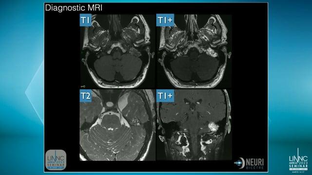 Presurgical embolization of a endolymphatic sac tumor (ELST) by direct puncture