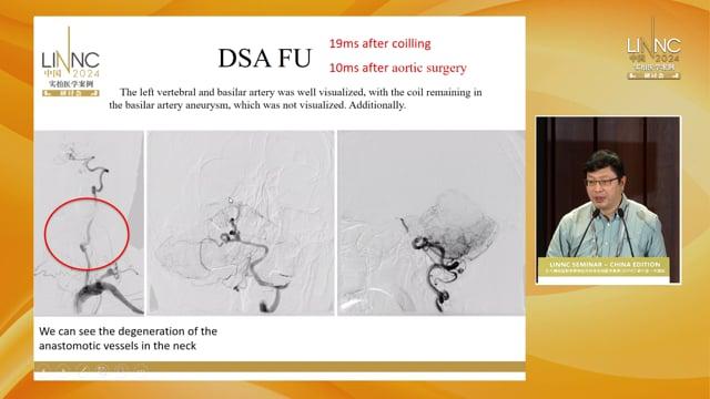 Interrupted aortic Arch with Ruptured Aneurysm