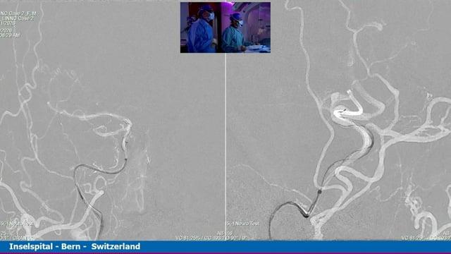 Bilateral chronic ICA occlusion