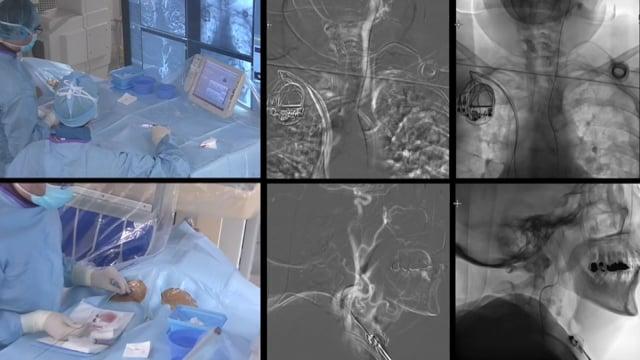 Ischemic stroke & Dural AVF