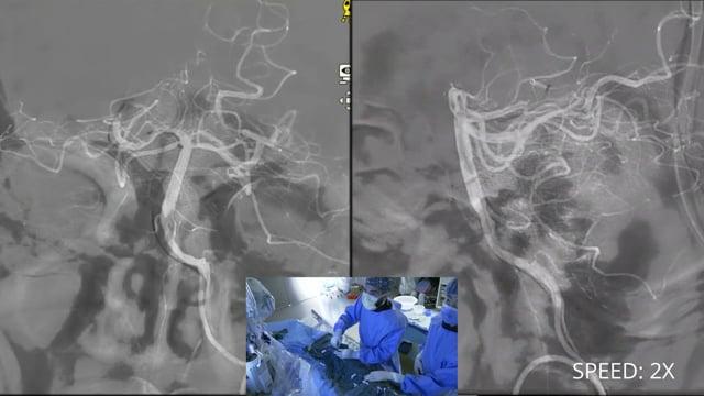 Right P1 occlusion treated combined technique