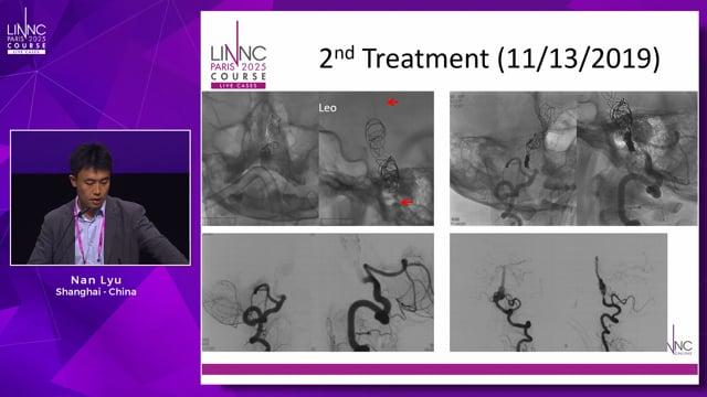 Staged Endovascular Treatment Of Vertebrobasilar Dolichoectasia