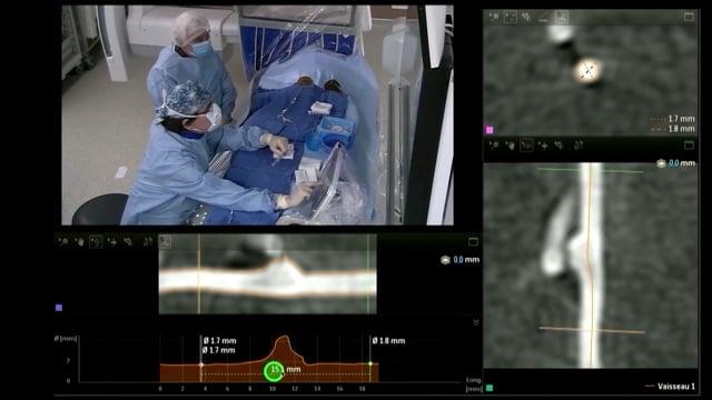 Flow diverters or stents-coils for distal aneurysms: enemy brothers?