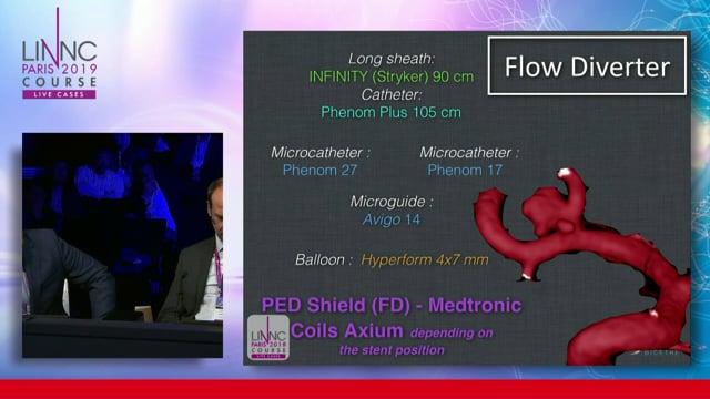 Treating bifurcation aneurysms with a stent diverter and coils
