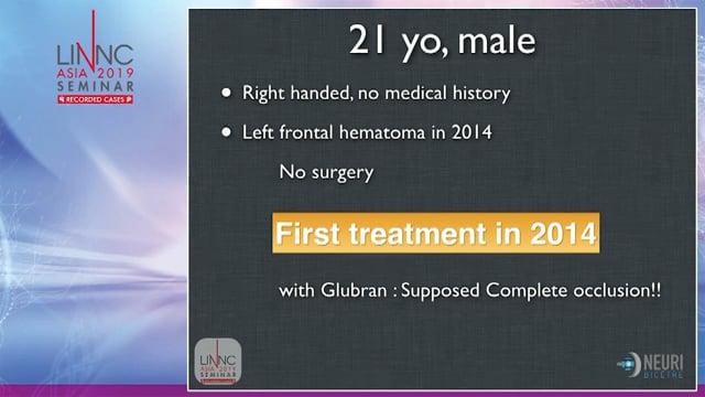 Double access to treat a remnant of a left frontal AVM first treated 10 years ago