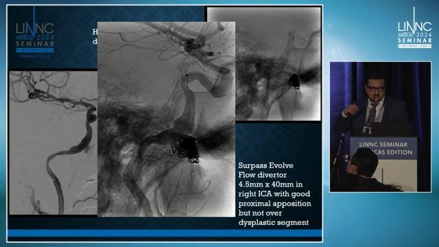 Carotid Blowout x 3 - Technical nuances, lessons learnt and a life saved!